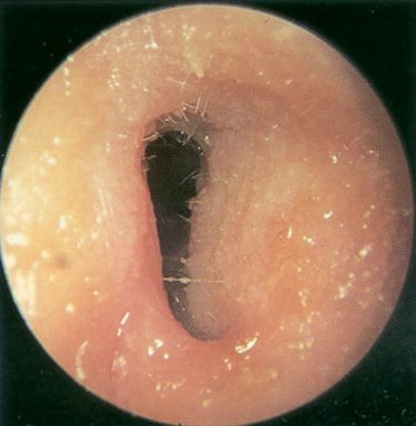 Acute otitis externa