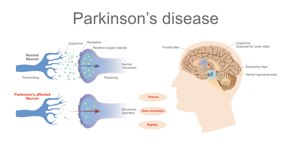Parkinson Hastalarında Orta Kulak Bulguları