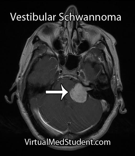 Vestibüler Schwannoma Nedir? Vestibüler schwannoma (VS) [akustik nörinom], denge bozukluğunun tümöral nedenleri arasında birinci sıradadır.
