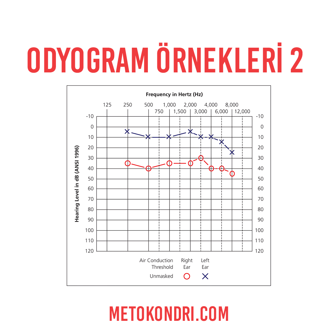 Odyogram Örnekleri 2