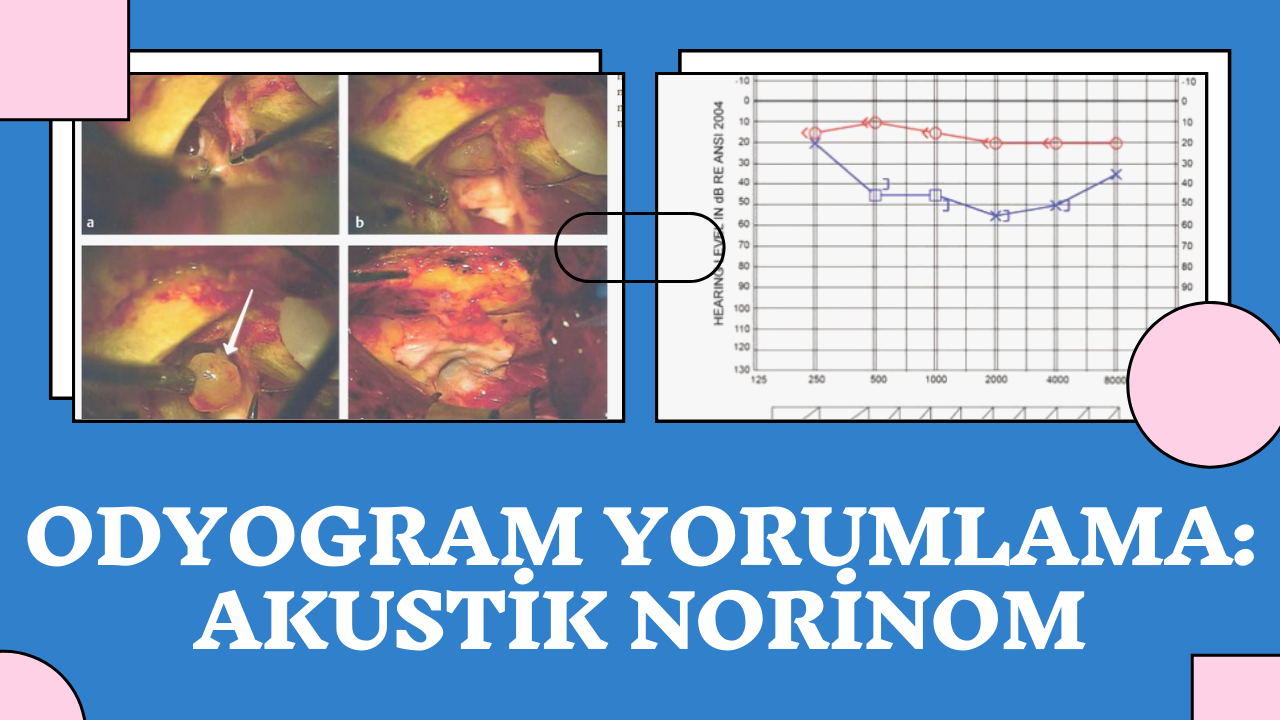 Odyogram Yorumlama #1: Akustik Norinom